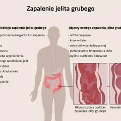 Objawy zapalenia jelit: biegunka, krew w kale, bóle brzucha, gorączka, osłabienie. Ilustracja porównuje zdrową i zapalną błonę śluzową jelit.