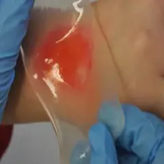 Ręce w niebieskich rękawiczkach przykładają przezroczysty plaster hydrożelowy gojący na zaczerwienioną skórę.