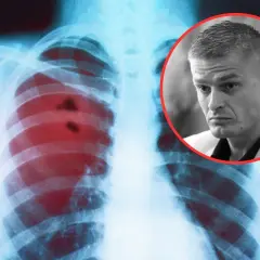 RTG płuc z zaczerwienionymi zmianami, sugerującymi raka płuc objawy. Obok twarz mężczyzny w okręgu.