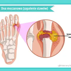 Dna moczanowa: zapalenie stawu palucha z kryształami kwasu moczowego. Jakie badania pomogą zdiagnozować tę chorobę?