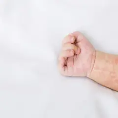 Dziecko ma zaczerwienioną wysypkę na ręce.
