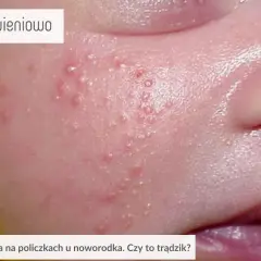 Skóra niemowlaka z widocznym trądzikiem niemowlęcym na policzku. Małe, czerwone krostki i grudki.
