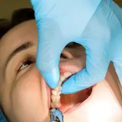 Dentysta w niebieskiej rękawiczce delikatnie podtrzymuje policzek pacjentki, pokazując zęby. Czas, po jakim zdejmuje się szwy, zależy od zabiegu.