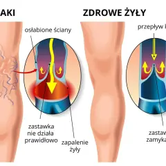 Ilustracja pokazuje nogę z widocznymi żylakami, porównując ją ze zdrową żyłą. Pokazuje, jak osłabione ściany i wadliwe zastawki prowadzą do zapalenia żył.