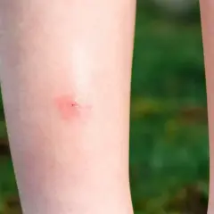 Czerwona, swędząca plamka na skórze, będąca efektem ugryzienia meszki.