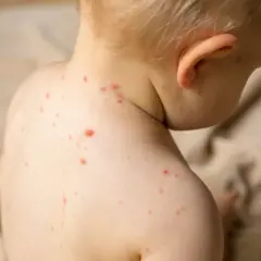 Widoczne czerwone kropki na skórze dziecka to objawy ospy.