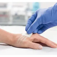 Ręka z raną zeszytą za pomocą plastrów zamiast szwów. Rękawiczka medyczna zakłada ostatni plaster.