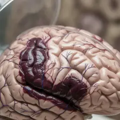 Model mózgu z ciemnym obszarem, symbolizującym krwiak mózgu. Szanse na przeżycie zależą od wielu czynników.