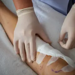 Opatrunek na nodze, pokazujący etapy gojenia rany pooperacyjnej. Ręce w rękawiczkach medycznych zakładają opatrunek.