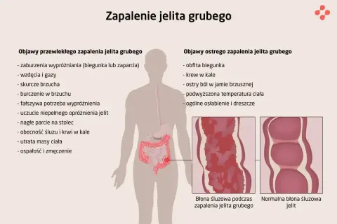 Objawy zapalenia jelit: biegunka, krew w kale, bóle brzucha, gorączka, osłabienie. Ilustracja porównuje zdrową i zapalną błonę śluzową jelit.