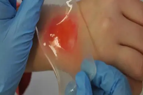 Ręce w niebieskich rękawiczkach przykładają przezroczysty plaster hydrożelowy gojący na zaczerwienioną skórę.