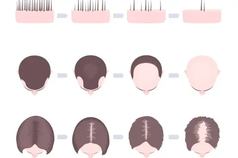 Ilustracja pokazuje postępujące łysienie plackowate u dzieci, od pełnych włosów do całkowitej utraty.