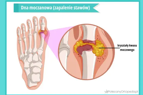 Dna moczanowa: zapalenie stawu palucha z kryształami kwasu moczowego. Jakie badania pomogą zdiagnozować tę chorobę?