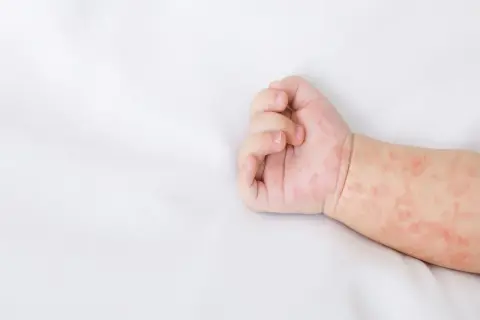 Dziecko ma zaczerwienioną wysypkę na ręce.