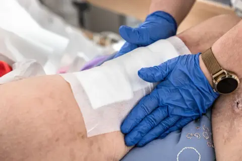 Opatrunek na nodze z odleżyną 3 stopnia. Ręce w niebieskich rękawiczkach przykładają biały opatrunek.