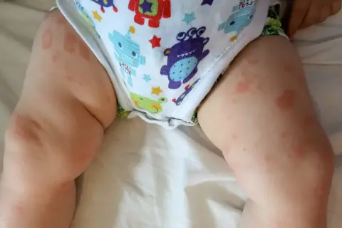 Czerwone plamy na skórze dziecka, widoczne na udach i wokół pieluszki, mogą wskazywać na uczulenie na mleko modyfikowane.