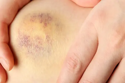 Dłoń obejmuje kolano z widocznym, fioletowo-żółtym siniakiem. Szukasz co na siniaki?