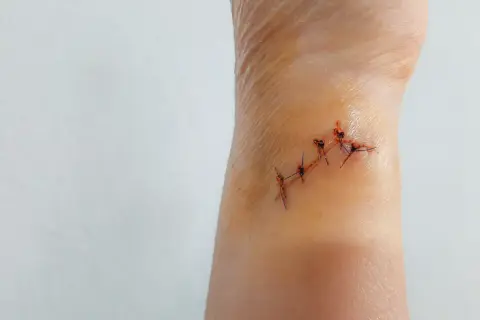 Rana krwawi po zdjęciu szwów, widać kilka kropli krwi wokół nacięcia na skórze.