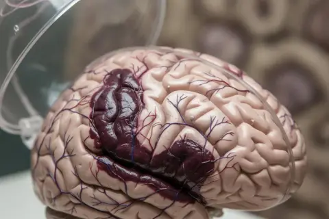 Model mózgu z ciemnym obszarem, symbolizującym krwiak mózgu. Szanse na przeżycie zależą od wielu czynników.