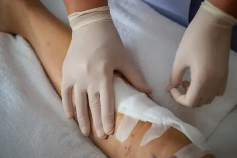 Opatrunek na nodze, pokazujący etapy gojenia rany pooperacyjnej. Ręce w rękawiczkach medycznych zakładają opatrunek.
