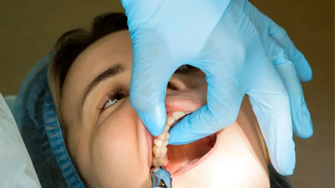 Dentysta w niebieskiej rękawiczce delikatnie podtrzymuje policzek pacjentki, pokazując zęby. Czas, po jakim zdejmuje się szwy, zależy od zabiegu.