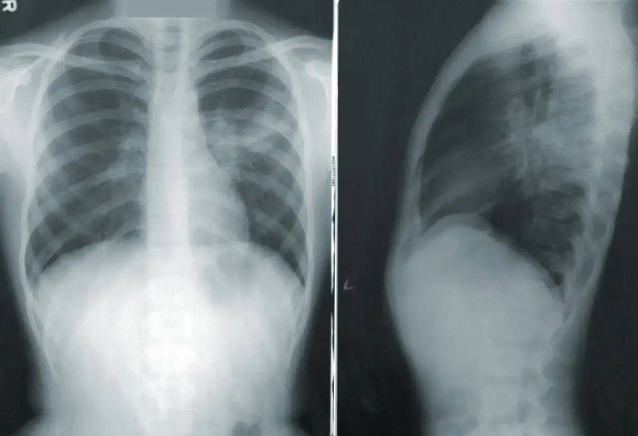 RTG klatki piersiowej w projekcji AP i bocznej. Widoczne zmiany sugerujące odma płucna.