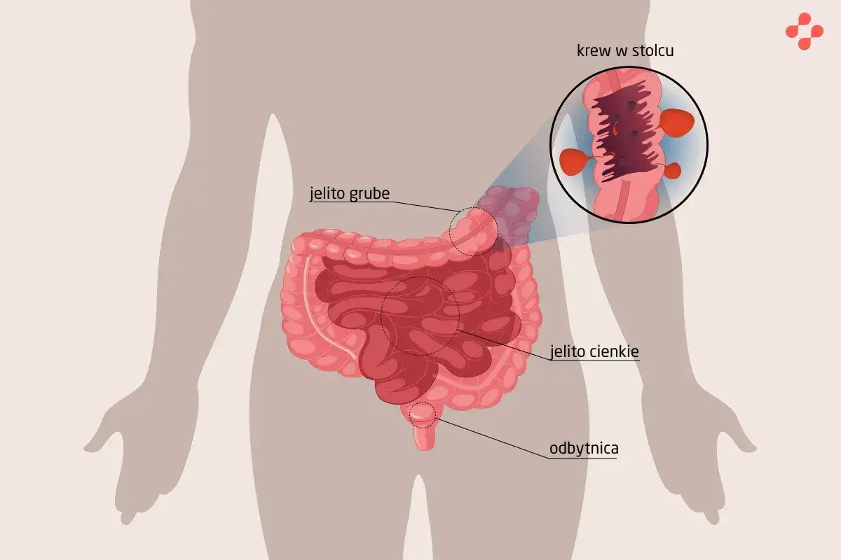 Ilustracja przedstawia jelito grube i cienkie, odbytnicę oraz powiększony widok krwi w stolcu, co może wskazywać na hemoroidy u dzieci.