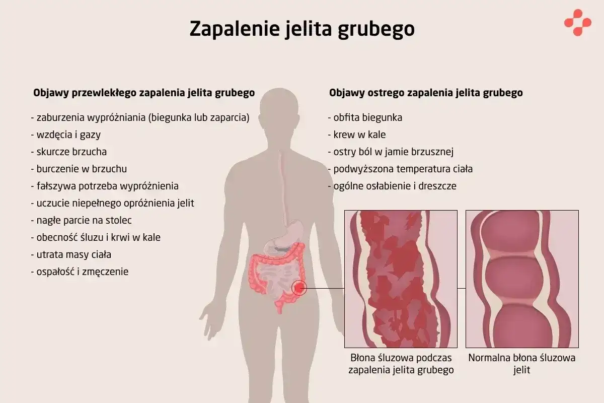 Objawy zapalenia jelit: biegunka, krew w kale, ból brzucha, gorączka, wzdęcia, utrata masy ciała. Porównanie błony śluzowej jelit.
